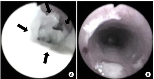 Figure 2. (A) Fiberoptic bronchoscopy showing a thick tubular, rubber-like, whitish pseudomembrane moulding covering 2∼3  cm  of  the  tracheal  wall  at  the  level  of  the  endotracheal  cuff  (the  arrows  indicate  the  pseudomembrane  partially detac