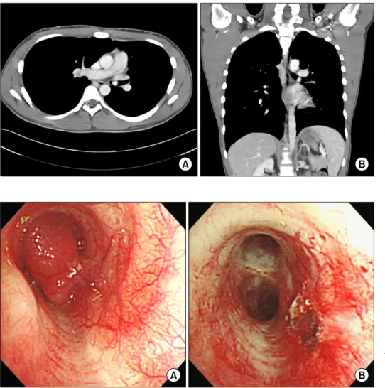 Figure 1. (A) Enhanced CT scan  of  thorax  show  a  round,  well  defined,   endo-bronchial  mass  in  the  left  main bronchus