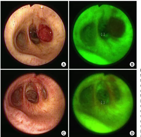 Figure  2.  Bronchoscopic  findings.  (A)  and  (B)  show  the opening of superior  seg-ment  of  right  lower   bron-chus  was  obstructed  by  fungating intraluminal mass.