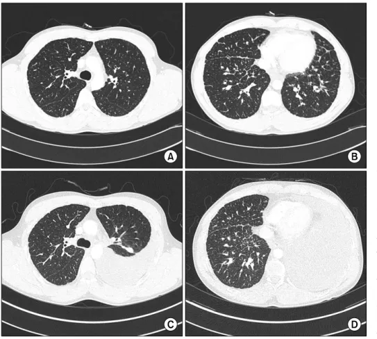 Figure  1.  Chest  X-ray  shows  peripheral  and  axial  inter- inter-stitial  thickening  in  both  lungs  with  left  pleural  effusion.