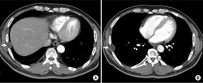 Figure 2. Histopathological examination shows the laminated cyst wall (arrow) of  Echinococcus with fibrosis in the pleura (A,  H&amp;E  stain,  ×12.5)  and  the  germinal  layer  (arrow)  of  Echinococcus  (B,  H&amp;E  stain,  ×400).