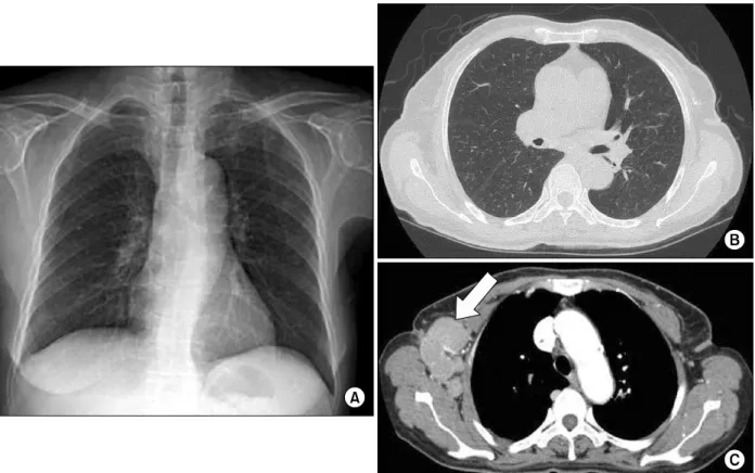 Figure  3.  Chest  X-ray  (A)  and  computed  tomography  (B)  taken  15  months  after  anti-tuberculosis  medication  shows decreased  infiltration  in  both  lung  fields,  but  axillary  lymph  nodes  (arrow)  are  increased  in  number  and  size  (C)