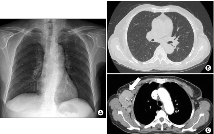 Figure  3.  Chest  X-ray  (A)  and  computed  tomography  (B)  taken  15  months  after  anti-tuberculosis  medication  shows decreased  infiltration  in  both  lung  fields,  but  axillary  lymph  nodes  (arrow)  are  increased  in  number  and  size  (C)