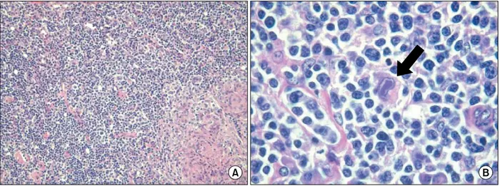 Figure 4. Biopsy taken after 15 months of antituberculosis medication shows multiple granulomatous lesions with diffused small  lymphocytes  and  scattered  macrophages  (A,  H&amp;E  stain,  ×40),  and  mononuclear  Reed-Stenberg  cells  (B,  arrow, H&amp