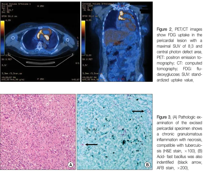 Figure  2.  PET/CT  images  show  FDG  uptake  in  the  pericardial  lesion  with  a  maximal  SUV  of  8.3  and  central photon defect area.