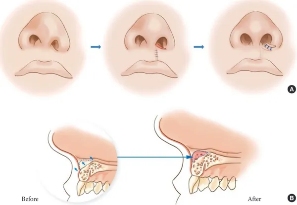 Fig. 3.  (A) B-flap and C-flap interdigitation and full-thickness skin graft can lengthen skin deficiency in the nostril floor