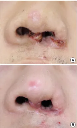 Fig. 7.  A full-thickness skin graft is aesthetically pleasing following  scar maturation