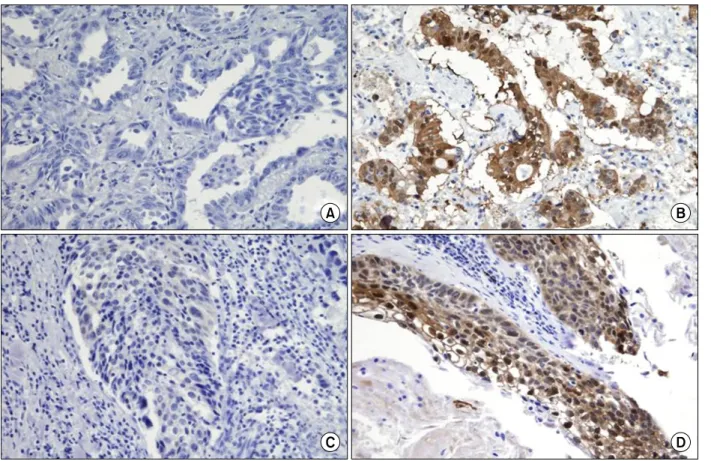 Figure  1.  Immunohistochemical  staining  for  maspin  using  the  tissue  microarray  (×200)