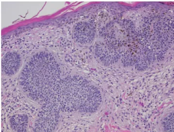 Fig. 1.  Preoperative photograph showing the lines drawn along tu- tu-mor margins for resection.