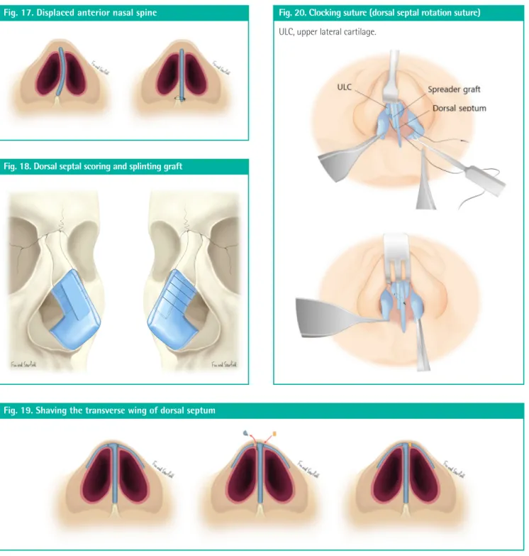 Fig. 17. Displaced anterior nasal spine