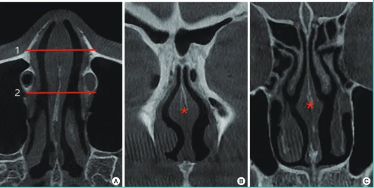 Fig. 1. Septal swell body (asterisk) on CT scan