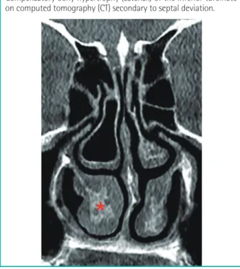 Fig. 2. Hypertrophy of inferior turbinate on CT scan