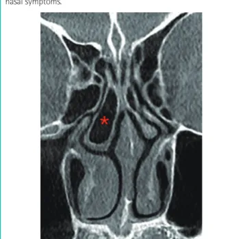 Fig. 9. A concha bullosa on CT scan