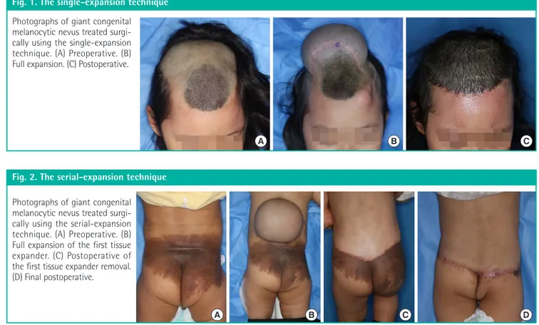 Fig. 1. The single-expansion technique Photographs of giant congenital  melanocytic nevus treated  surgi-cally using the single-expansion  technique