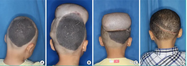 Fig. 4. The serial expansion in scalp