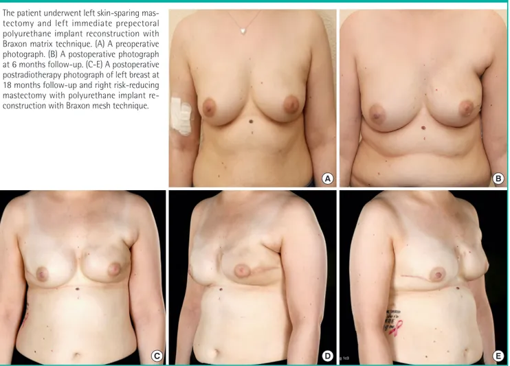 Fig. 1. A case of prepectoral polyurethane breast reconstruction