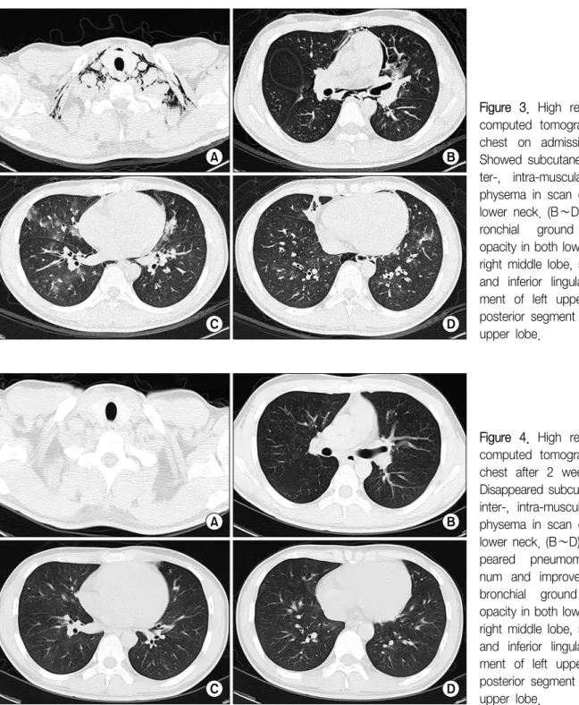 Figure  3.  High  resolution  computed  tomography  of  chest  on  admission.  (A)  Showed  subcutaneous   in-ter-,  intra-muscular   em-physema  in  scan  covered  lower  neck