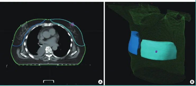 Fig. 1.  Breast volume measurements using CT images