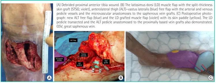 Fig. 1. Recycled flap pedicle in lower extremity reconstruction