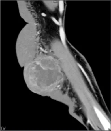 Fig. 3.  Intraoperative photo. The upper arm mass. Fig. 5.  The forearm mass was diagnosed as high-grade sarcoma with pos- pos-sible malignant peripheral nerve sheath tumor with frequent mitosis (about  53 mitosis/10 high-power fields) and necrosis (<60