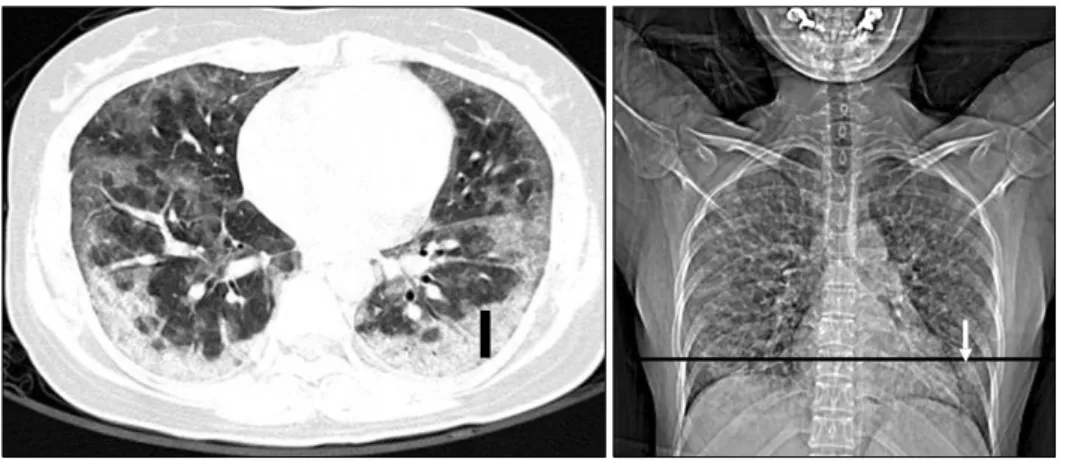 Figure  1.  HRCT  axial  im- im-age &amp; CT scanogram. The most adequate biopsy site  was decided on axial scan (short  bar),  and  matched  with  CT  scanogram  (black  line)