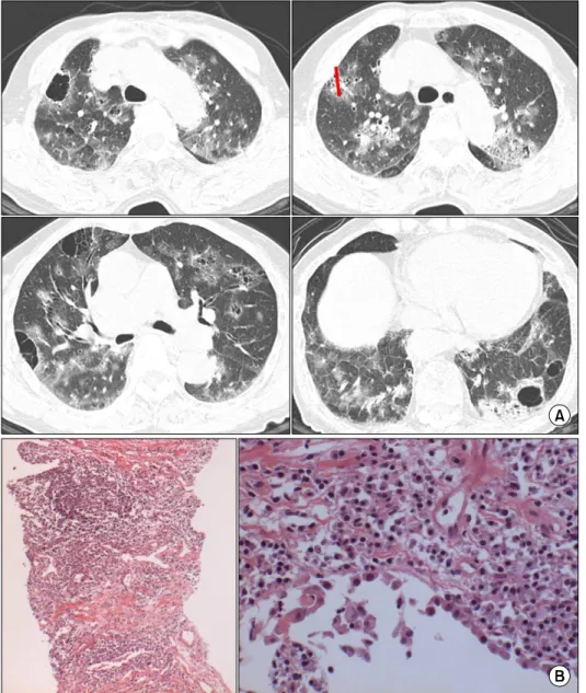 Figure  4.  Sixty  four  year  old  woman  complaining  slowly  progressing   dysp-nea  for  4  years