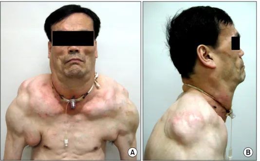 Figure  1.  Anterior  (A)  and  lateral  (B)  view  of  the   pa-tient  show  multiple,   sym-metric  subcutaneous  fatty  masses  in  neck,  shoulder  and  upper  trunk.