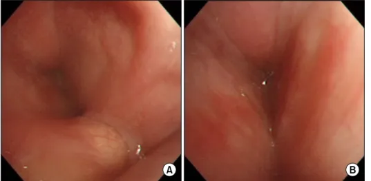 Figure  4.  Bronchoscopy  shows  tense  swelling  in  supraglottic  region  (A)  and  false  vocal  cord  (B).