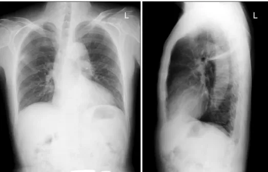 Figure 2. Chest PA and lat- lat-eral  view  showed  the   im-provement of previous  con-solidation 4 weeks after the steroid  therapy  stopped.