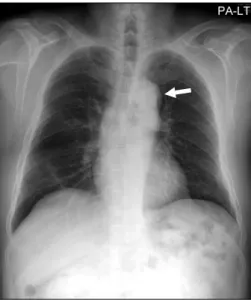Figure 1. Chest radiograph shows a well-demarcated, lo- lo-bulated  mass  in  the  left  anterior  mediastinum  (arrow).