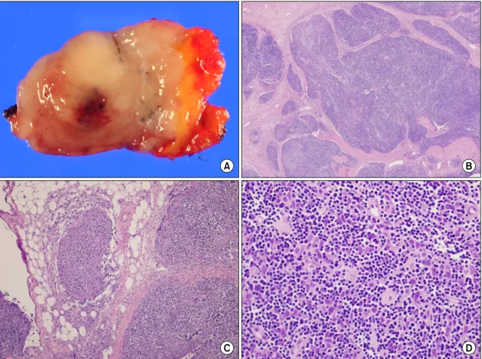 Figure 5.  (A) Gross findings of the tumor showing tan-colored nodular pattern with whitish fibrous bands