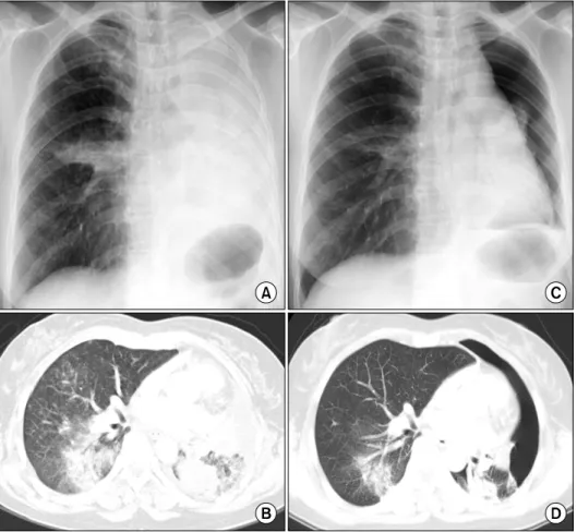 Figure 1. Chest X-ray and computed tomography were performed before treatment with erlotinib (A, B)