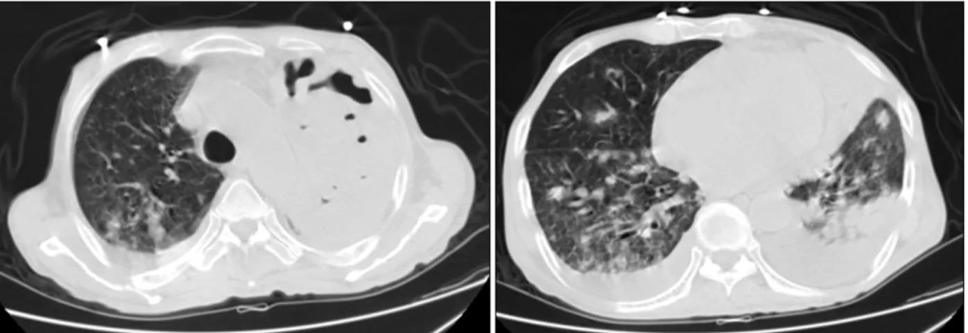 Figure  1.  Initial  chest  X-ray  showed  air  containing  con- con-solidation and abscess at left lung and multiple small  nod-ules  at  both  lungs.