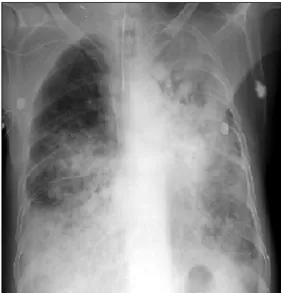 Figure  4.  Last  chest  X-ray  showed  progressive  con- con-solidation  at  both  lower  lungs.