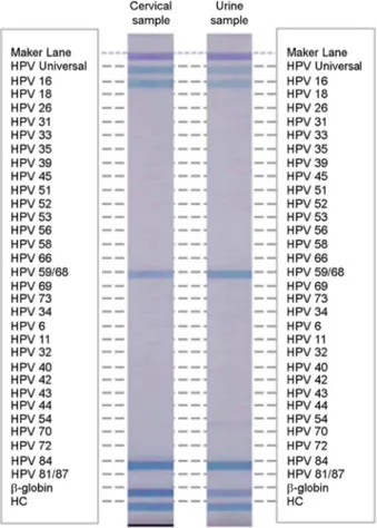 Table 1. Comparison of HPV detection rate and HPV genotype concordance rate between cervical and urine samples  Urine samples  Concordance  rate (%)  κ (95% IC) Positive  n (%)  Negative n (%)  Cervical  samples  HPV  Positive    27 (25.0)  13 (12.0)  76.8