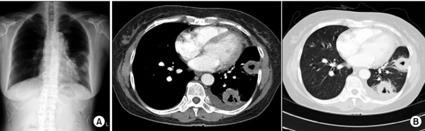 Figure  1.  Initial  chest  X-ray  shows  infiltrations  with  nodular  densities  in  left  middle  and  left  lower  lung  (A)
