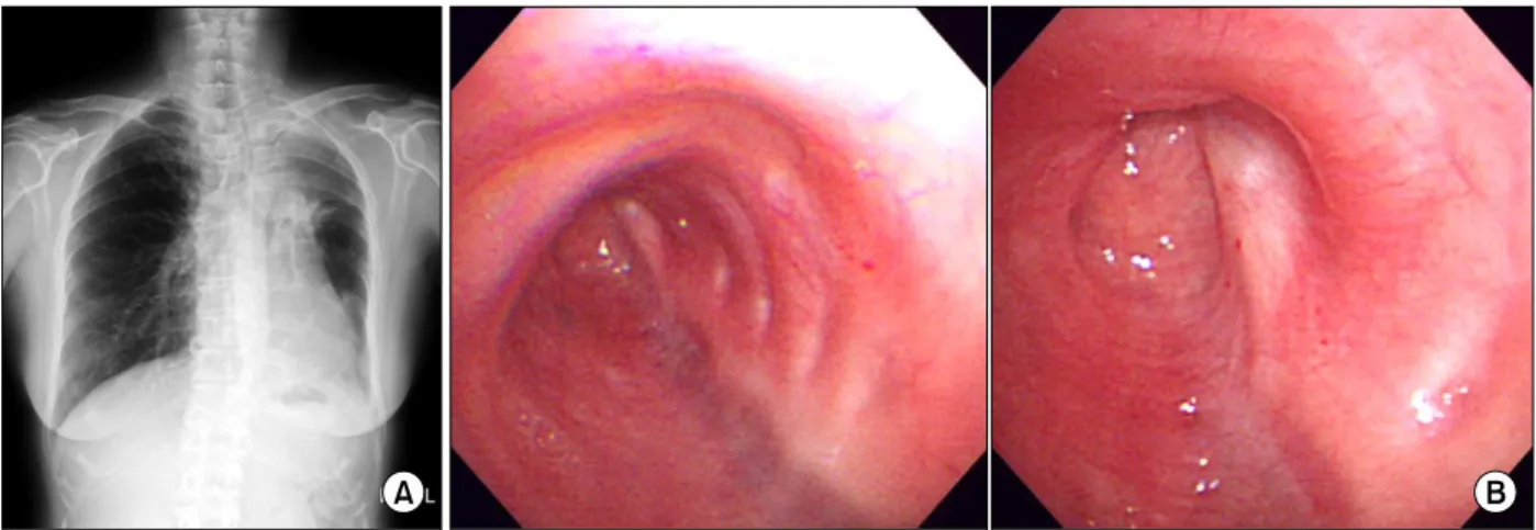 Figure  3.  Microscopic  finding  of  chronic  granulomatous inflammation  suggesting  mycobacterial  infection  (H&amp;E  stain,  ×100)