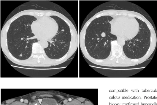 Figure 2. Abdominopelvic computed tomography demon- demon-strates  an  enlarged  prostate  with  irregular  cystic  lesions (arrow)  and  a  2×1  cm  sized  nodular  enhancing  mass  (arrowhead)  in  the  right  seminal  vesicle.