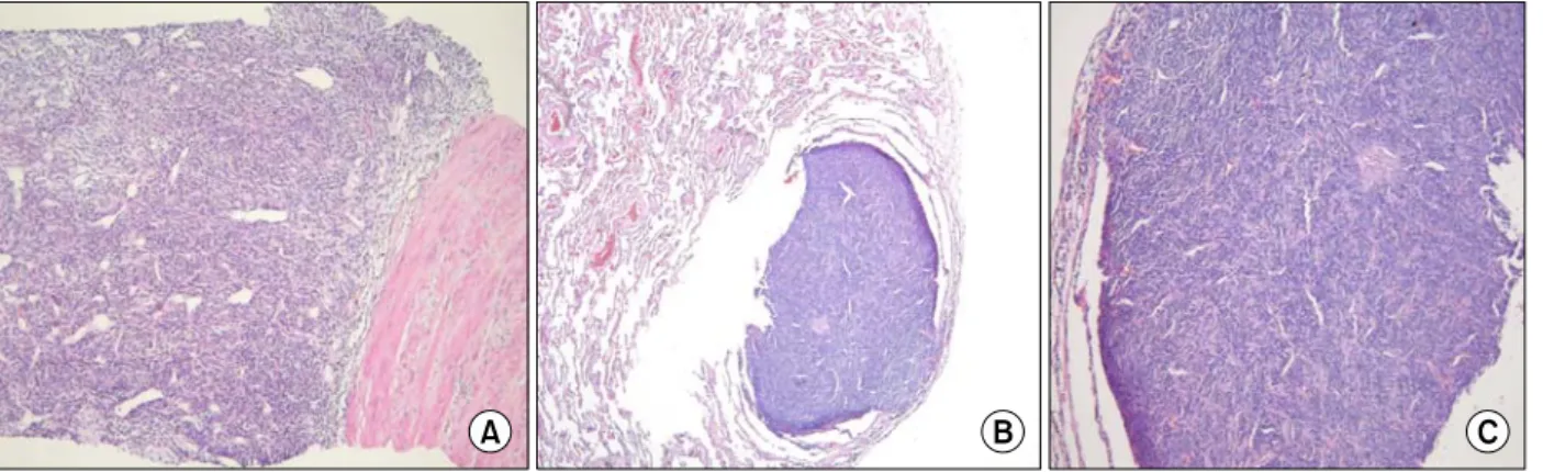 Figure  3.  Prostate  biopsy  shows  moderately  hypercellular  stroma  with no  cytologic atypia,  mitosis  or  necrosis (A, H&amp;E  stain,  ×100)