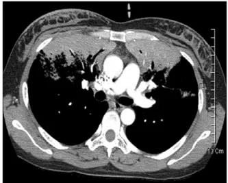 Figure  2.  Chest  CT  shows  non-segmental  distribution  of  bilateral  consolidation  in  both  lung  field.