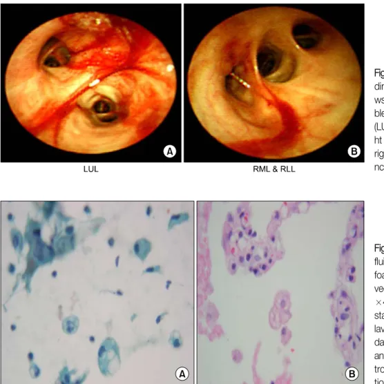 Figure  4.  TBLB  and  BAL  fluid slide. (A) TBLB shows  foamy  macrophage  in   al-veolar  spaces  (H&amp;E  stain, 