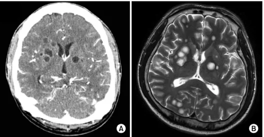 Figure 2. Brain CT (A) obtained 33 days after the near-drowning accident  and axial T2 weighted MR image (B) showed multiple  hyperintense  lesions  with  slightly  hypointense  rim  with  minimal  surrounding  edema.