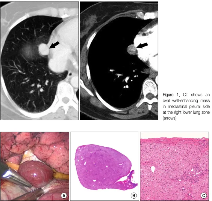 Figure  1.  CT  shows  an  oval  well-enhancing  mass  in  mediastinal  pleural  side  at the right lower lung zone (arrows).