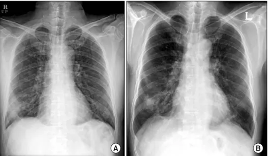 Figure 1. (A) Chest X-ray shows increased infiltration in right lower lung field on admission and (B) decreased infiltration in  right  lower  lung  field  after  2  days.
