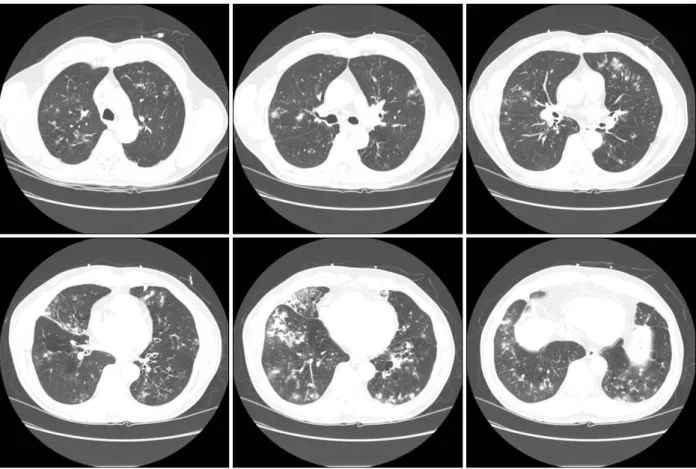 Figure  2.  Chest  X-ray  shows  multiple  nodular  opacities  at  both  lung  filed  during  treatment