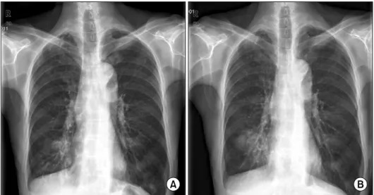 Figure  1.  Preoperative  chest  X-ray.  Right  middle  lobe  infiltration  had  increased  after  1  year  later