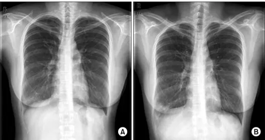 Figure  4.  Preoperative  chest  X-ray.  Right  lower  lobe  infiltration  had  increased  after  1  year  later