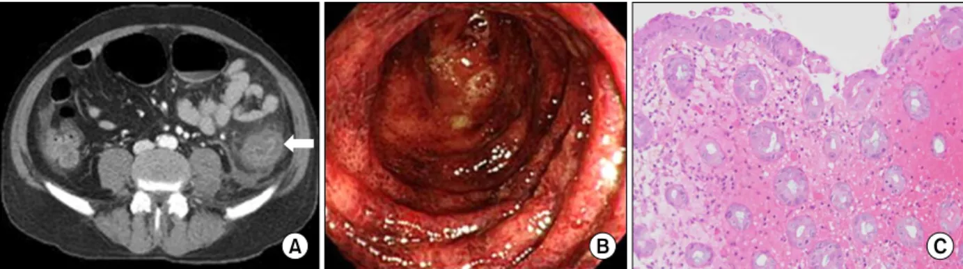 Figure  1.  (A)  Computed  tomography  finding  shows  long  segmental  and  concentric  wall  thickening,  called  “double  halo sign” (arrow),  from  sigmoid to  distal  transverse  colon,  without  significant  stenosis  or  obstruction  in  mesenteric 