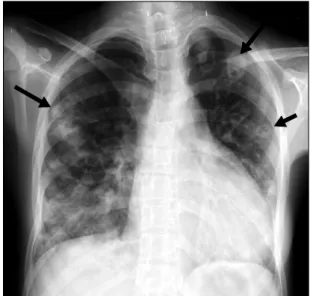 Figure  1.  The  chest  radiograph  shows  multiple  cavitary nodules  (arrows)  in  both  lungs