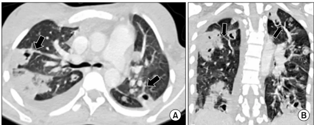 Figure 2. (A) The chest CT scan reveals bilateral peripheral nodules and  wedge-shaped consolidation with various size.